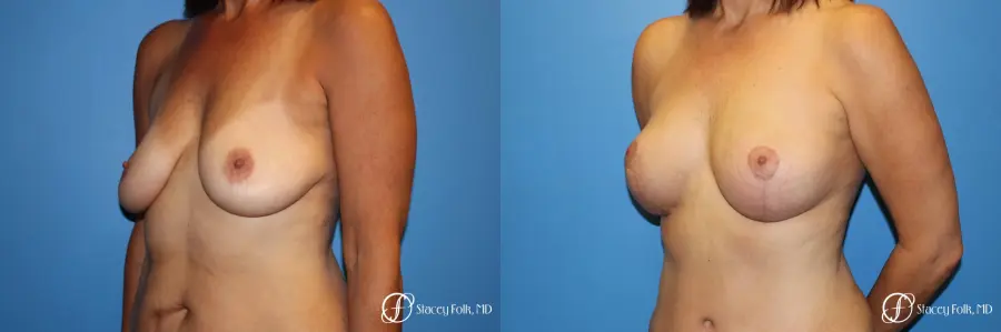 Denver Fat Transfer Breast Lift Mastopexy with Fat Transfer to the Breast 6916 - Before and After 2