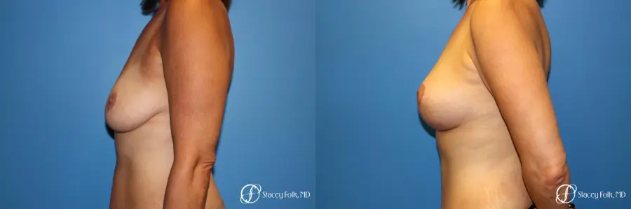 Denver Fat Transfer Breast Lift Mastopexy with Fat Transfer to the Breast 6916 - Before and After 3