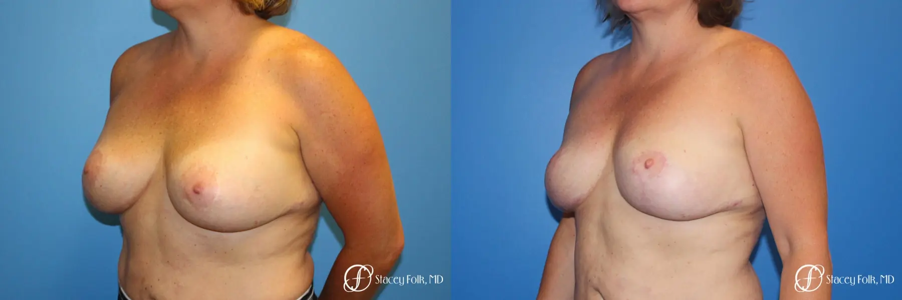 Breast Revision - Removal of Implant, Fat Transfer, Breast Lift (Mastopexy) - Before and After 2