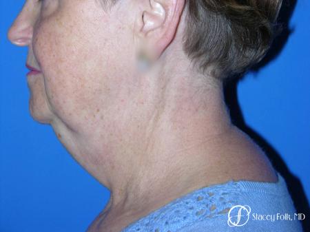 Denver Facial Rejuvenation Face Lift and Fat Injections 7130 - Before Image 1