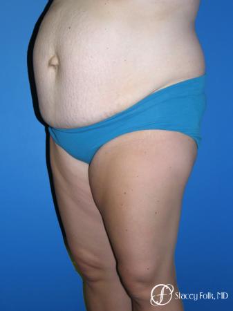 Denver Tummy Tuck - Abdominoplasty 7714 - Before Image 2