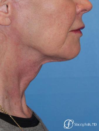 Denver Facial Rejuvenation Face lift, Fat Injections, and Laser Resurfacing 7131 - After Image 1