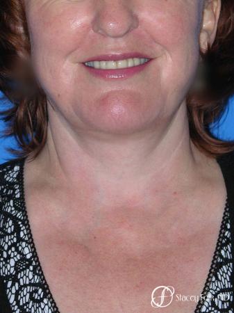 Denver Facial Rejuvenation Face lift, Fat Injections, Laser Resurfacing 7133 - After Image 3