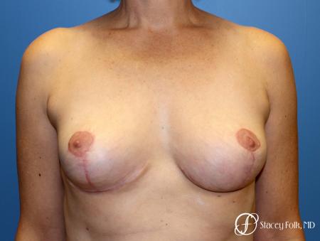 Denver Breast Reduction and Breast Lift - Mastopexy 8231 - After Image 1