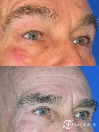 Denver Blepharoplasty 8273 - After Image 1