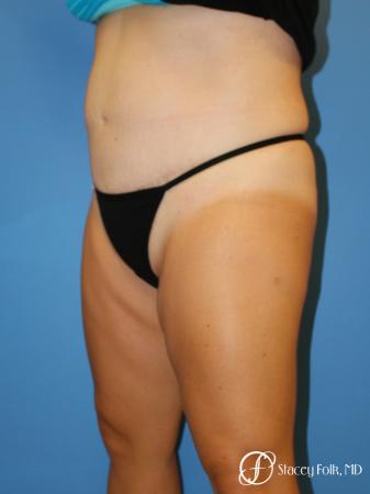 Denver Tummy Tuck - Abdominoplasty 7714 - After Image 2