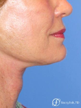 Denver Facial Rejuvenation Face Lift, Fat Injections, Laser Resurfacing 7116 - After Image 1