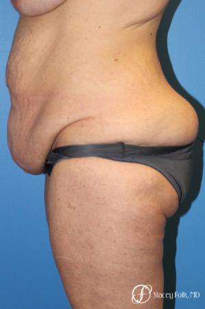 Denver Body Lift belt lipectomy, liposuction, mastopexy 5935 - Before and After Image 3