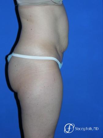 Denver Tummy Tuck 35 - Before and After Image 3
