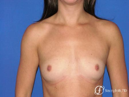 Denver Breast Augmentation 4779 - Before Image 1