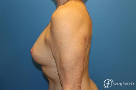 Denver Breast Revision 7990 - After Image 3