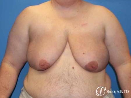 Denver Female to male top surgery 5258 - Before Image 1