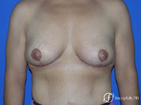 Denver Breast Lift - Mastopexy 7982 - After Image 1