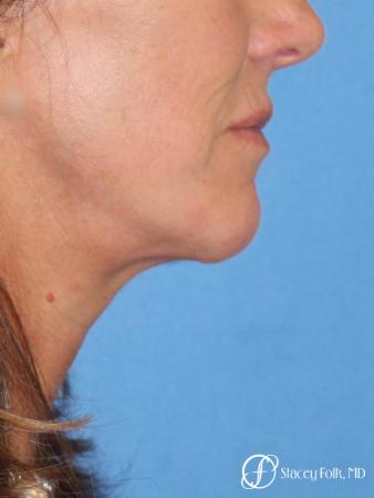 Denver Facial Rejuvenation Face lift, Fat Injections, and Laser Resurfacing 7132 - After Image 1