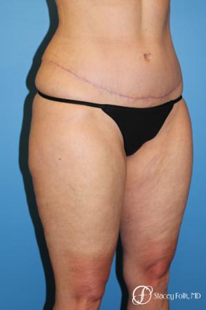 Tummy Tuck - Abdominoplasty - After Image 2