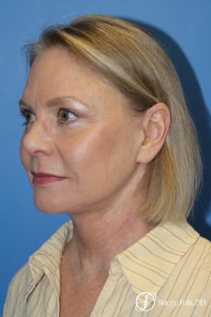 Facial Rejuvenation: Patient 1 - After Image 2