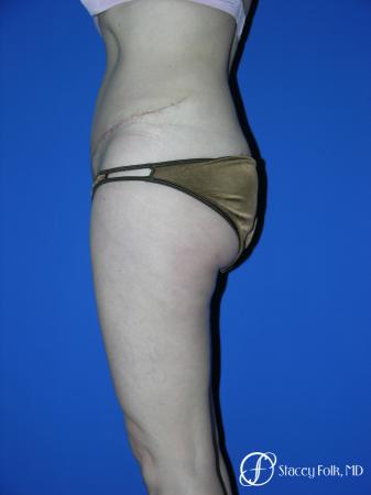 Denver Tummy Tuck 34 - After Image 2