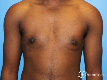 Denver FTM Female to male top surgery using gynecomastia technique 5497 - After Image 1
