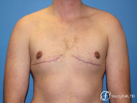 Denver FTM Female to Male Top Surgery 7708 - After Image 1