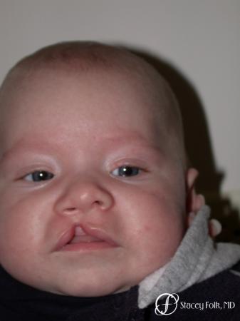 Denver Cleft Lip and Palate Repair 3305 - Before Image 1