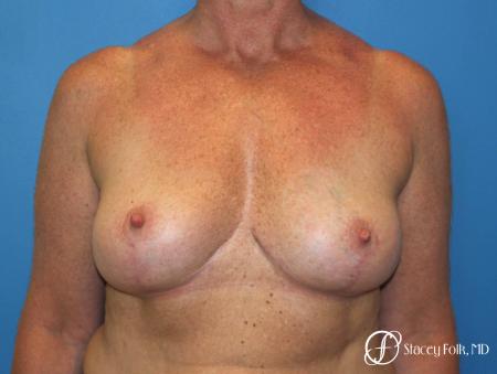 Denver Breast Revision 8543 - After Image 1