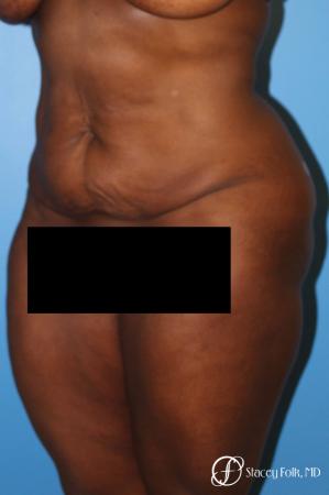 Denver Tummy Tuck - Abdominoplasty 7514 - Before Image 2