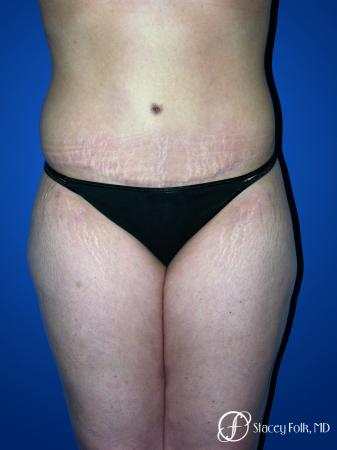 Denver Tummy Tuck 23 - After Image 1