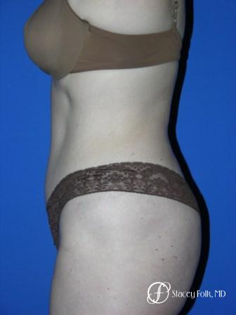 Denver Tummy Tuck 44 - After Image 3