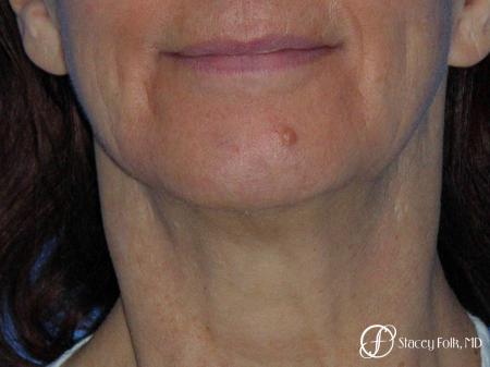 Denver Facial Rejuvenation Face Lift and Fat Injection 7124 - Before Image 1