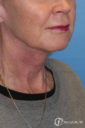 Denver Facial Rejuvenation Face lift, Fat Injections, and Laser Resurfacing 7131 - After Image 4