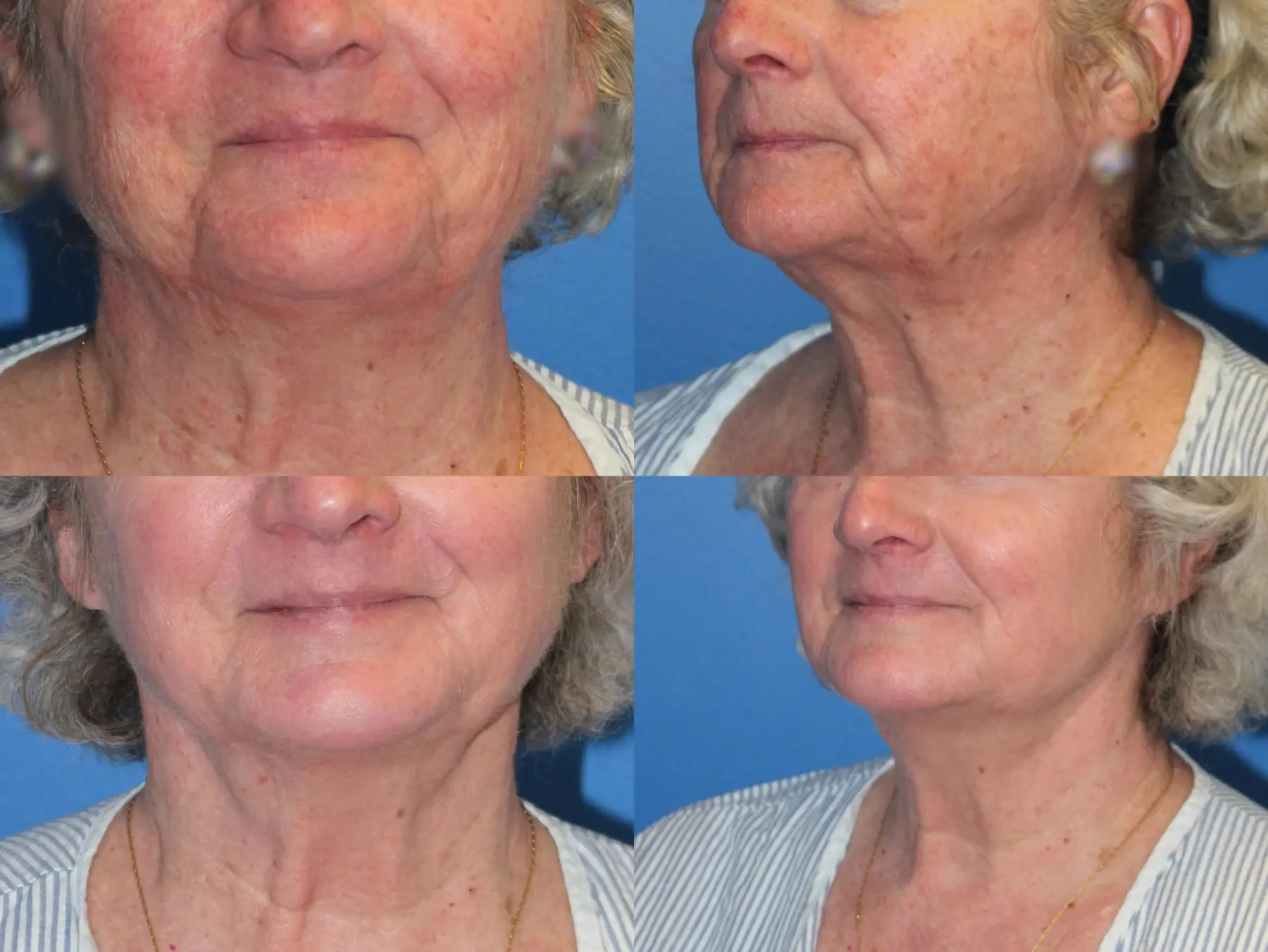 Denver J-Plasma Face Laser resurfacing with J-Plasma 10864 - Before and After