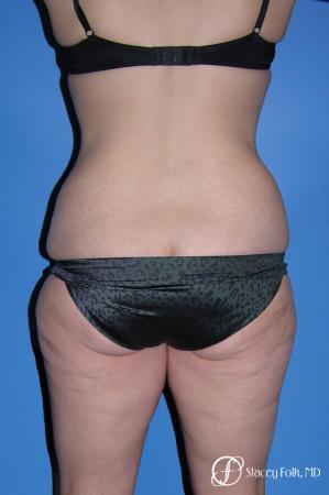 Denver Body Lift Belt lipectomy & liposuction 5264 - Before Image 2