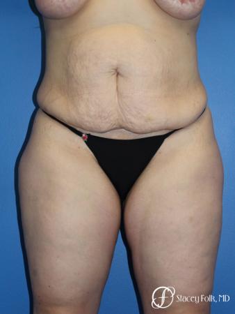 Tummy Tuck (Abdominoplasty) - Before Image 1