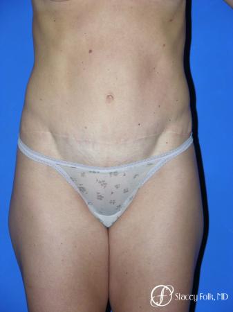 Denver Tummy Tuck 3528 - After Image 1