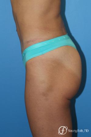 Denver Tummy Tuck - Abdominoplasty 8299 - After Image 3