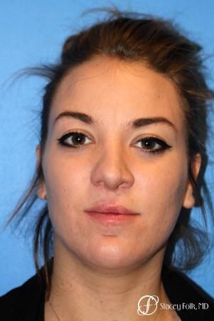 Denver Septorhinoplasty and Cleft Lip Repair 8162 - After Image 1