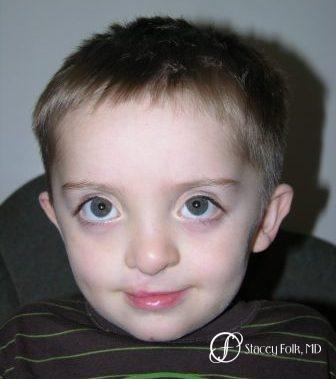Denver Cleft Lip and Palate Repair 965 - After Image 1