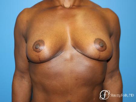 Denver Breast Lift - Mastopexy 7509 - After Image 1