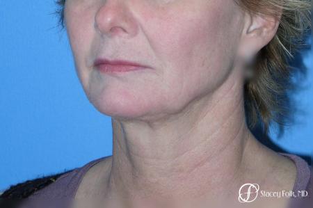 Denver Facial Rejuvenation Face Lift 7121 - Before Image 2