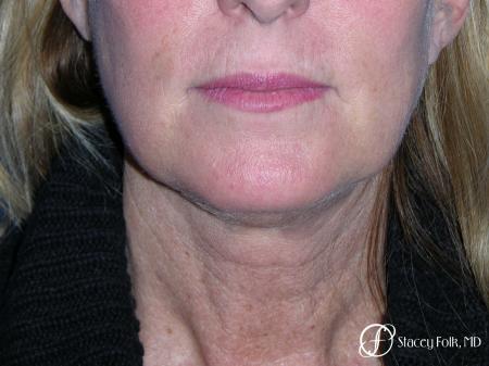 Denver Facial Rejuvenation 7916 - Before Image 1