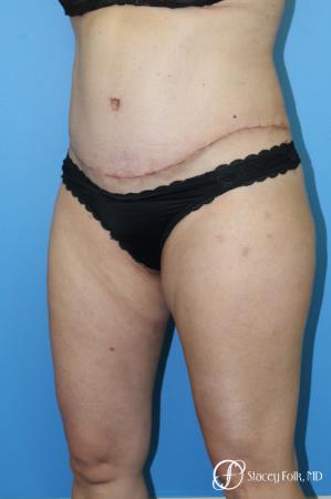 Tummy Tuck (Abdominoplasty) and Liposuction - After Image 3