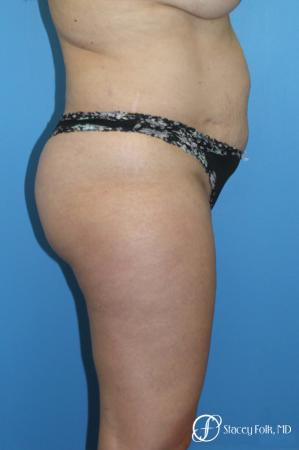 Tummy Tuck (Abdominoplasty) and Liposuction - Before and After Image 4