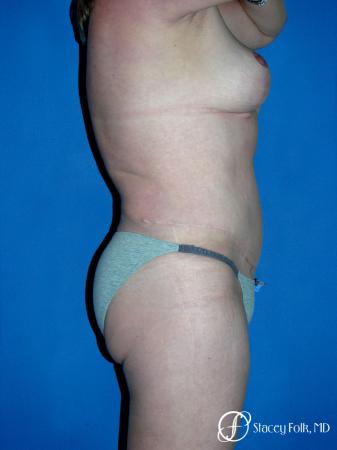 Denver Mommy makeover, breast reduction, abdominoplasty, liposuction 5355 - After Image 3
