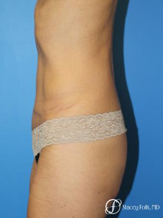 Denver Tummy Tuck Abdominoplasty 5609 - After Image 3