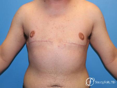 Denver FTM Top Surgery 5089 - After Image 1