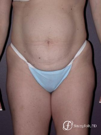 Denver Tummy Tuck 21 - Before Image 1