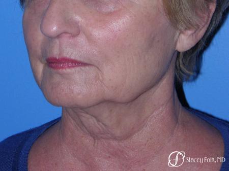 Denver Facial Rejuvenation Face Lift, Fat Injections, and Laser Resurfacing 7120 - Before Image 2