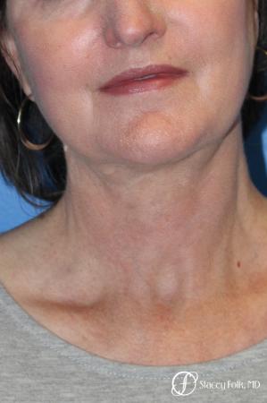 Denver Facial Rejuvenation Facelift, Blepharoplasty, Fat Transfer, Laser Resurfacing 10350 - After Image 2