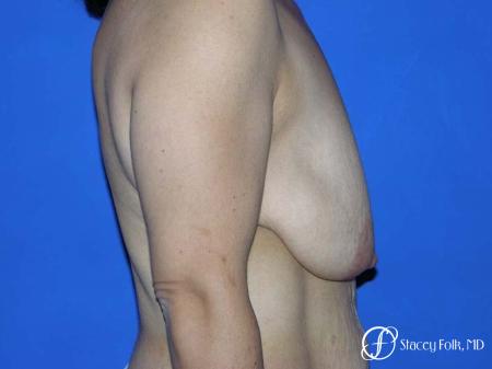 Denver Breast Lift - Mastopexy 7982 - Before and After Image 3