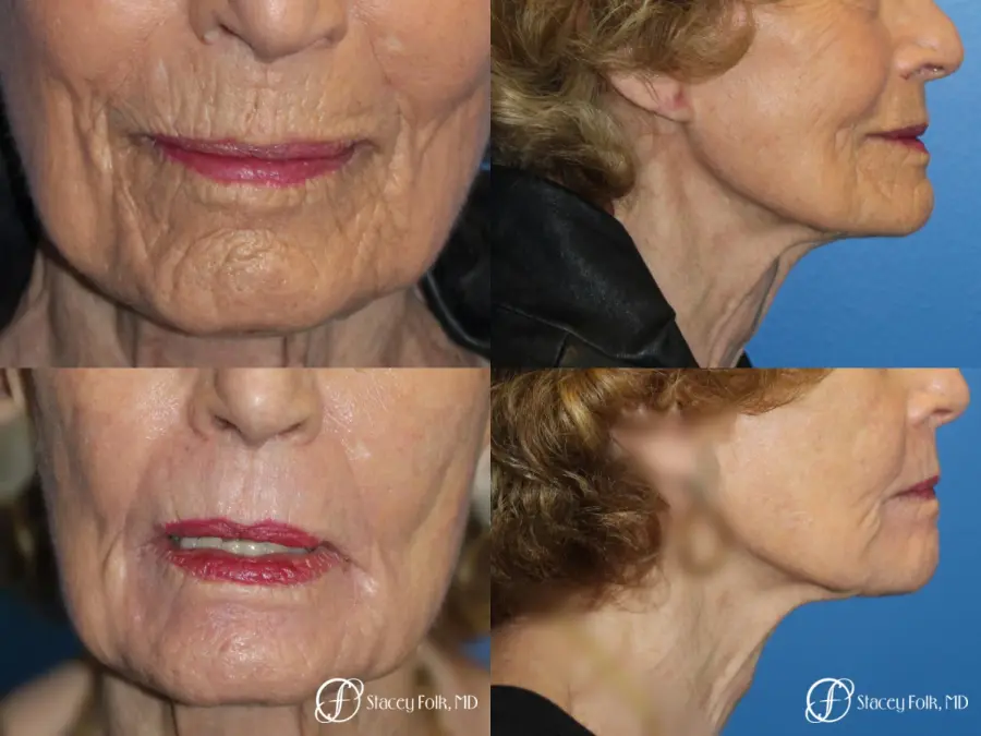 Laser Skin Resurfacing - Before and After